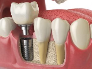 dantų implantacija